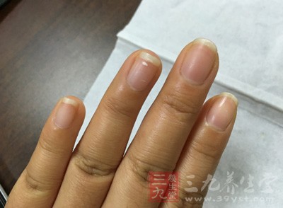 手指指甲出現(xiàn)扁圓形